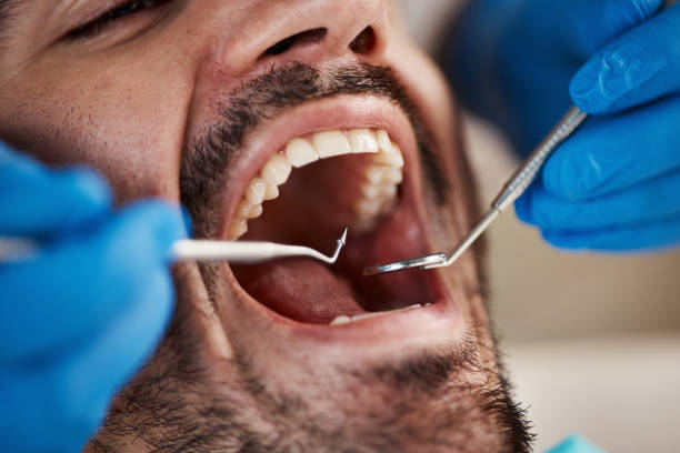 Best Emergency Wisdom Teeth Removal in Mayville, ND